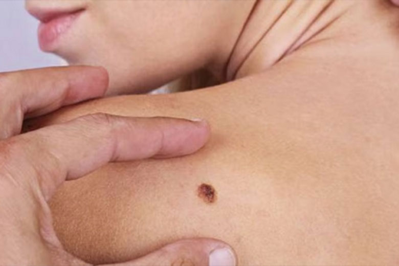 ¿Ya revisaste tus lunares?: Únete a la pesquisa de cáncer de piel
